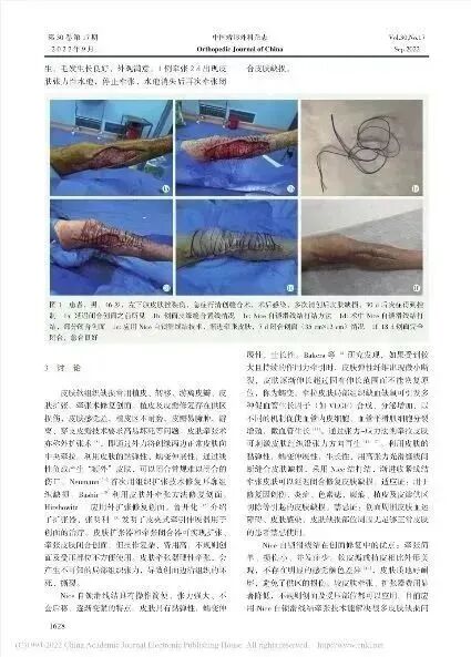 皮肤闭合器怎么拆荐读：如何使用Nice自锁线结牵张技术闭合皮肤创面？简单又有效！_https://www.jmylbn.com_新闻资讯_第26张