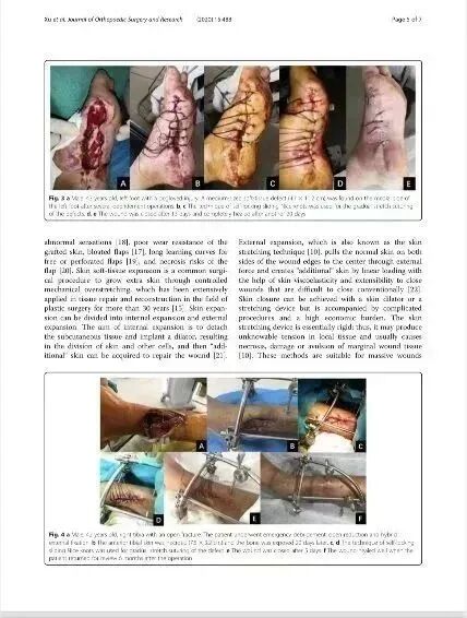 皮肤闭合器怎么拆荐读：如何使用Nice自锁线结牵张技术闭合皮肤创面？简单又有效！_https://www.jmylbn.com_新闻资讯_第23张