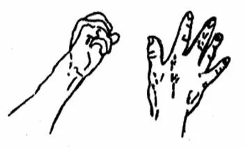 什么病忌用翻身床为什么临床必会 ｜ 15种骨科常见病的最佳术后体位+功能锻炼_https://www.jmylbn.com_新闻资讯_第4张