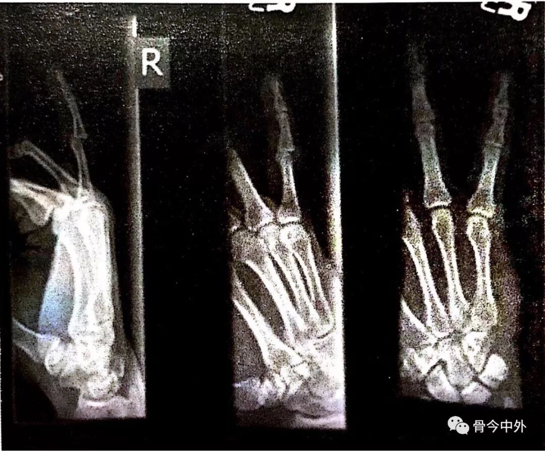 近指间 Pip 关节背侧骨折与脱位 实例讲解5种手术方式 骨今中外 微信公众号文章阅读 Wemp