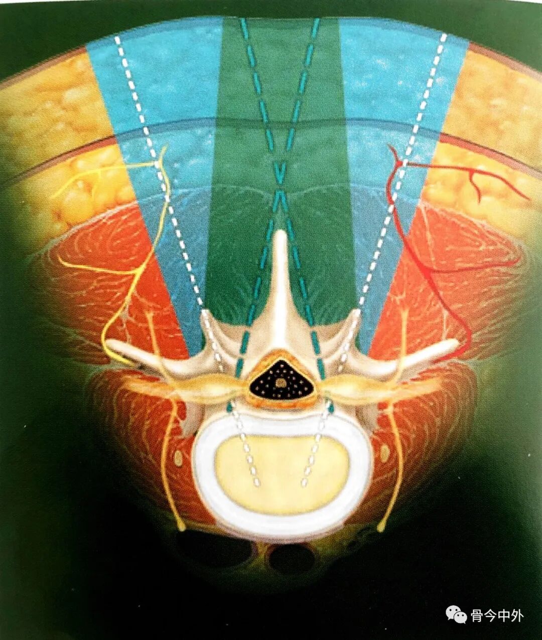 为什么要用皮钉缝合皮质骨螺钉技术：千万不能错过的手术精要！_https://www.jmylbn.com_新闻资讯_第2张