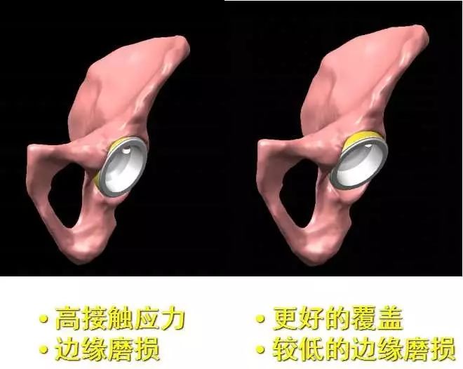 专题教程:如何精准重建陶瓷关节