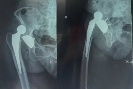 Illustration 2 for 全髋关节置换术后脱位为何高发？骨科专家揭秘核心原因，助您掌握预防与应对完整指南！