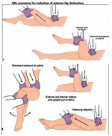 Illustration 6 for 全髋关节置换术后脱位为何高发？骨科专家揭秘核心原因，助您掌握预防与应对完整指南！