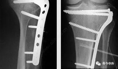 Illustration 1 for 骨科X C GammaPFN内固定物：取出难题专家全解答！判断取不取、最佳时机、安全方法，看完不再纠结！