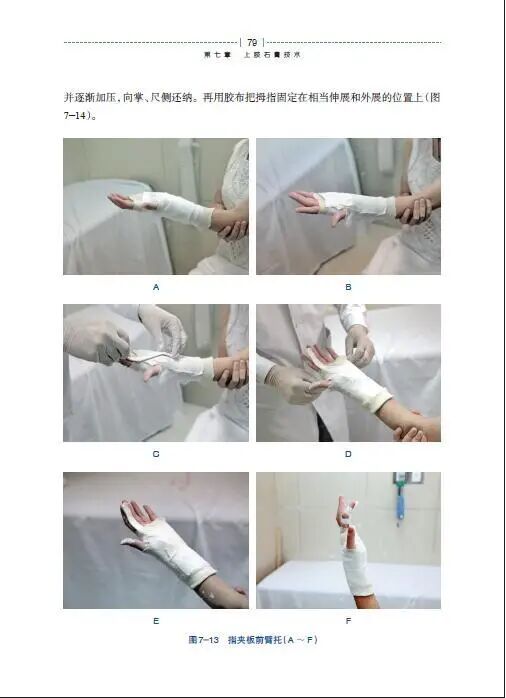 绷带石膏怎么拆除骨科石膏绷带外固定技术的操作要领，大量彩页直观明了！_https://www.jmylbn.com_新闻资讯_第8张