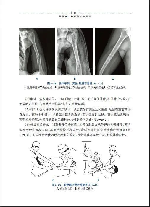 绷带石膏怎么拆除骨科石膏绷带外固定技术的操作要领，大量彩页直观明了！_https://www.jmylbn.com_新闻资讯_第7张