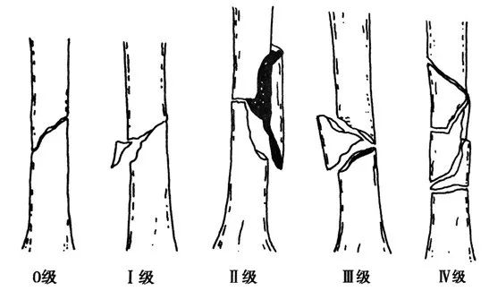 股骨骨折分型图解图片