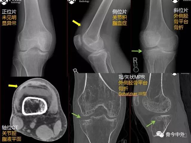 雙語病例 脛骨平台骨折引發的思考 骨今中外 微文庫