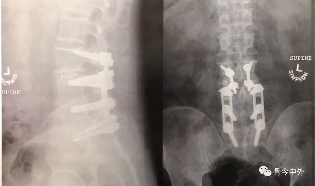 为什么要用皮钉缝合皮质骨螺钉技术：千万不能错过的手术精要！_https://www.jmylbn.com_新闻资讯_第3张