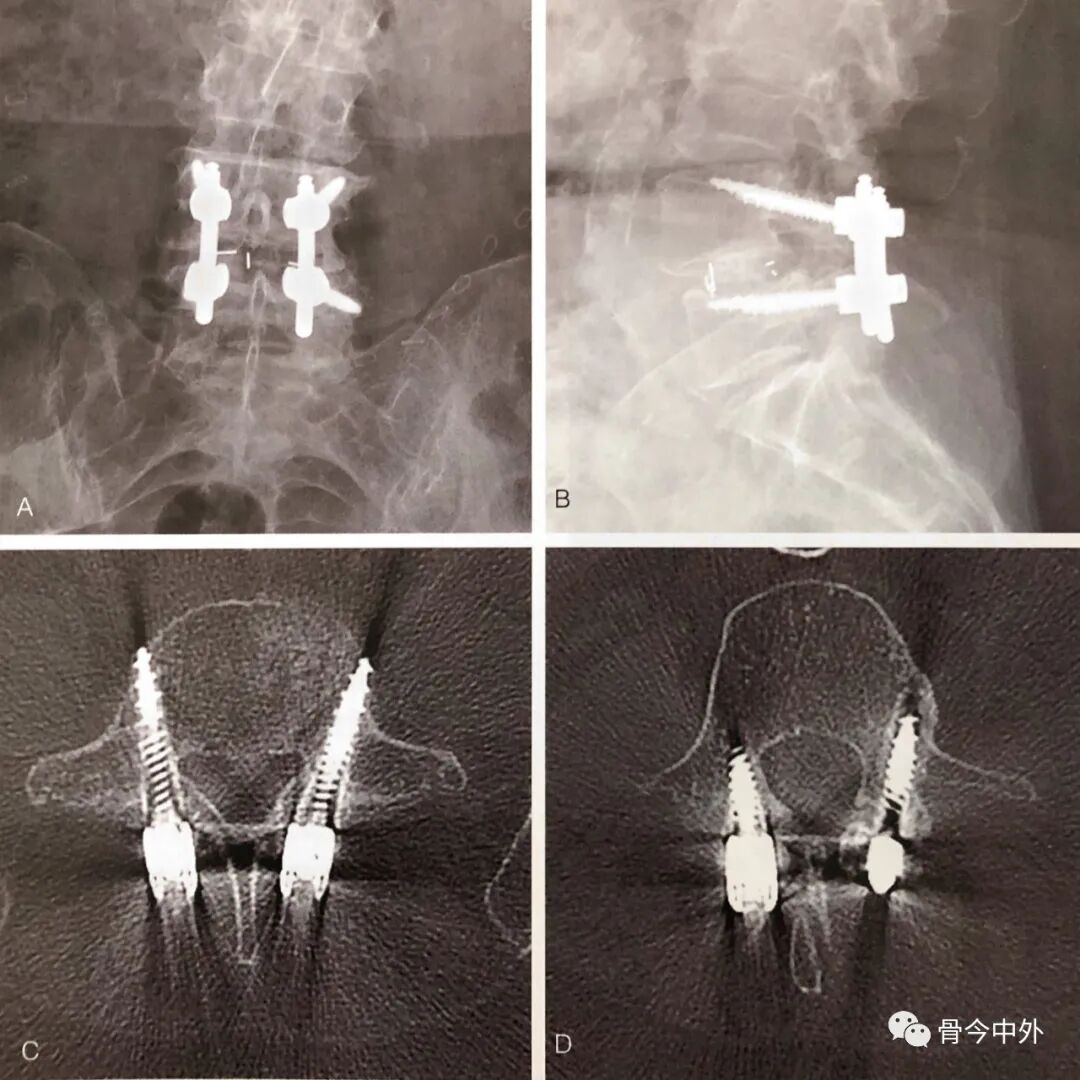 为什么要用皮钉缝合皮质骨螺钉技术：千万不能错过的手术精要！_https://www.jmylbn.com_新闻资讯_第4张