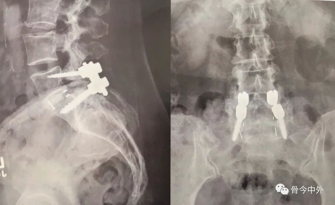 为什么要用皮钉缝合皮质骨螺钉技术：千万不能错过的手术精要！_https://www.jmylbn.com_新闻资讯_第6张