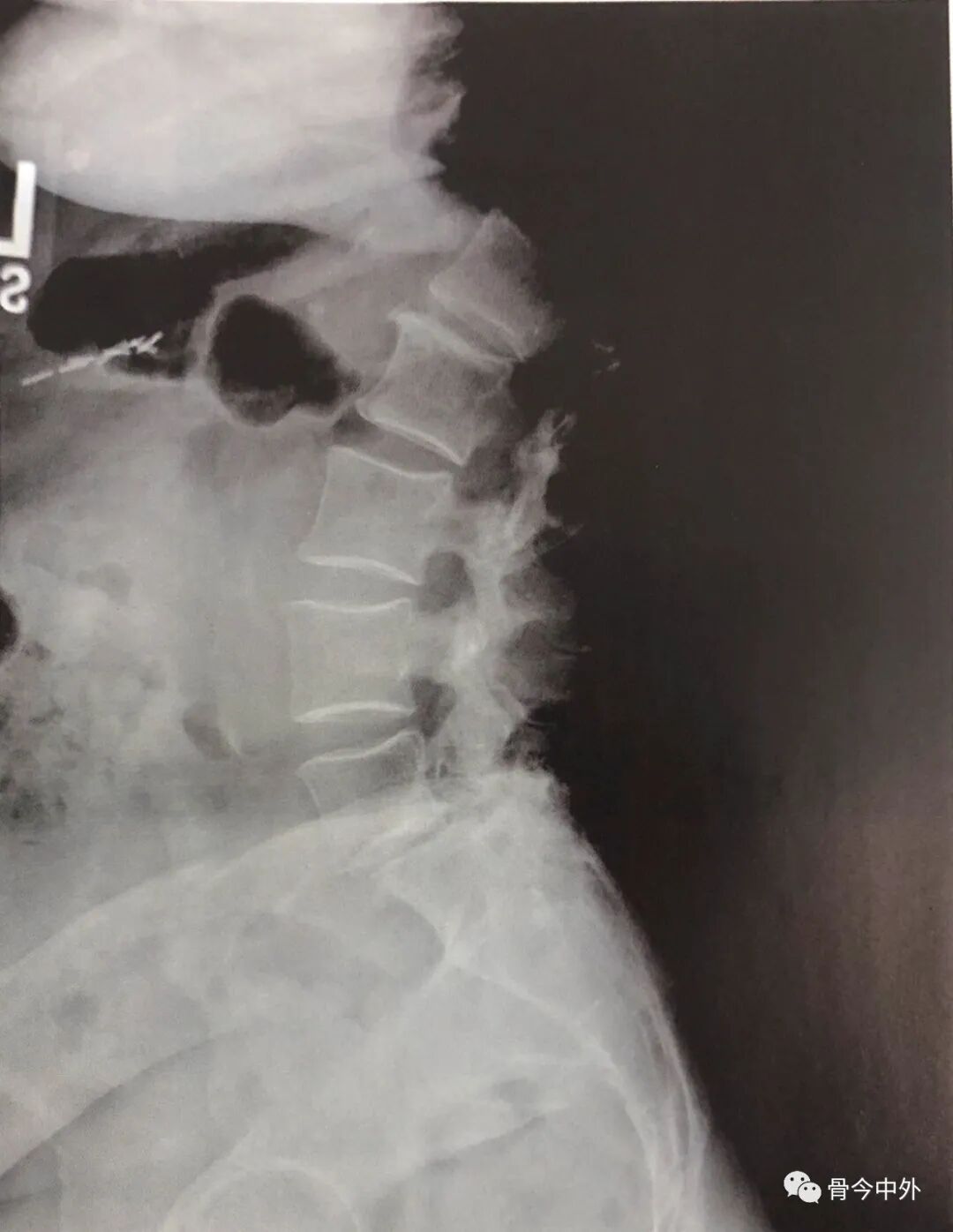 为什么要用皮钉缝合皮质骨螺钉技术：千万不能错过的手术精要！_https://www.jmylbn.com_新闻资讯_第5张