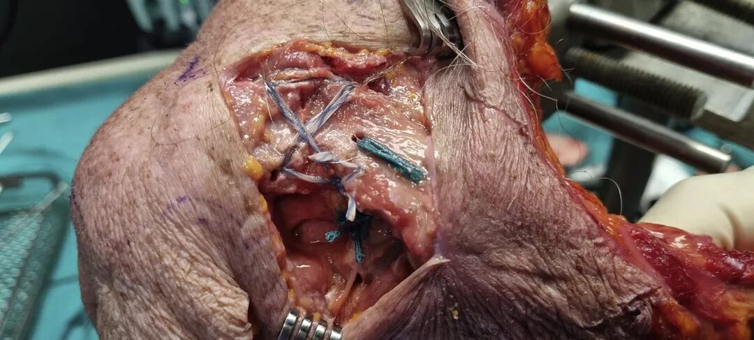 Illustration 3 for 突破传统！Neer II型V型锁骨远端不稳定骨折新解方：全缝合技术颠覆内固定，告别二次取出烦恼，助您稳固速愈，重获健康！