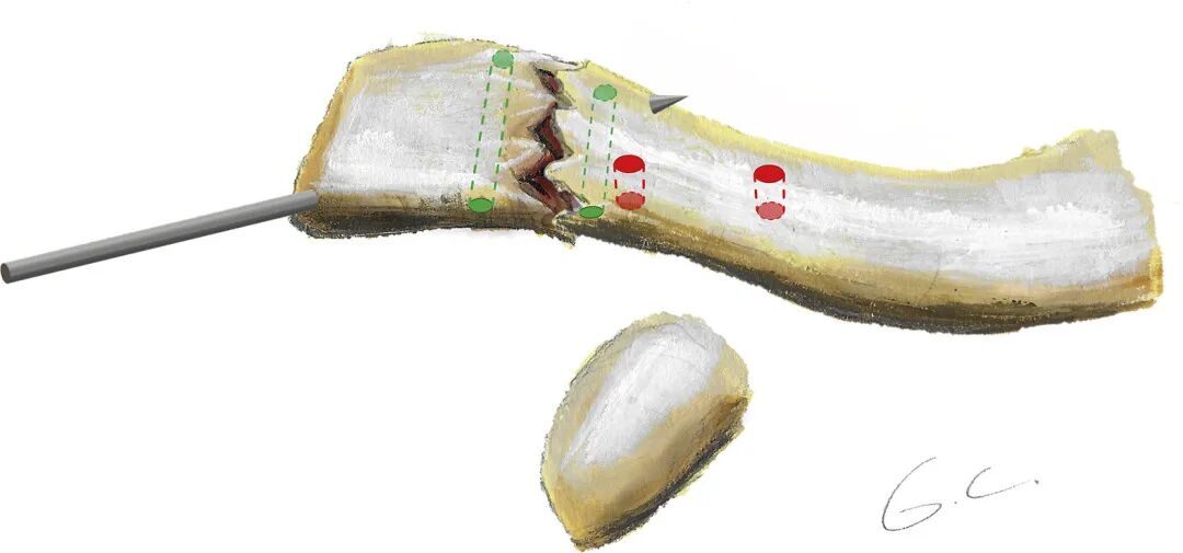 Illustration 1 for 突破传统！Neer II型V型锁骨远端不稳定骨折新解方：全缝合技术颠覆内固定，告别二次取出烦恼，助您稳固速愈，重获健康！