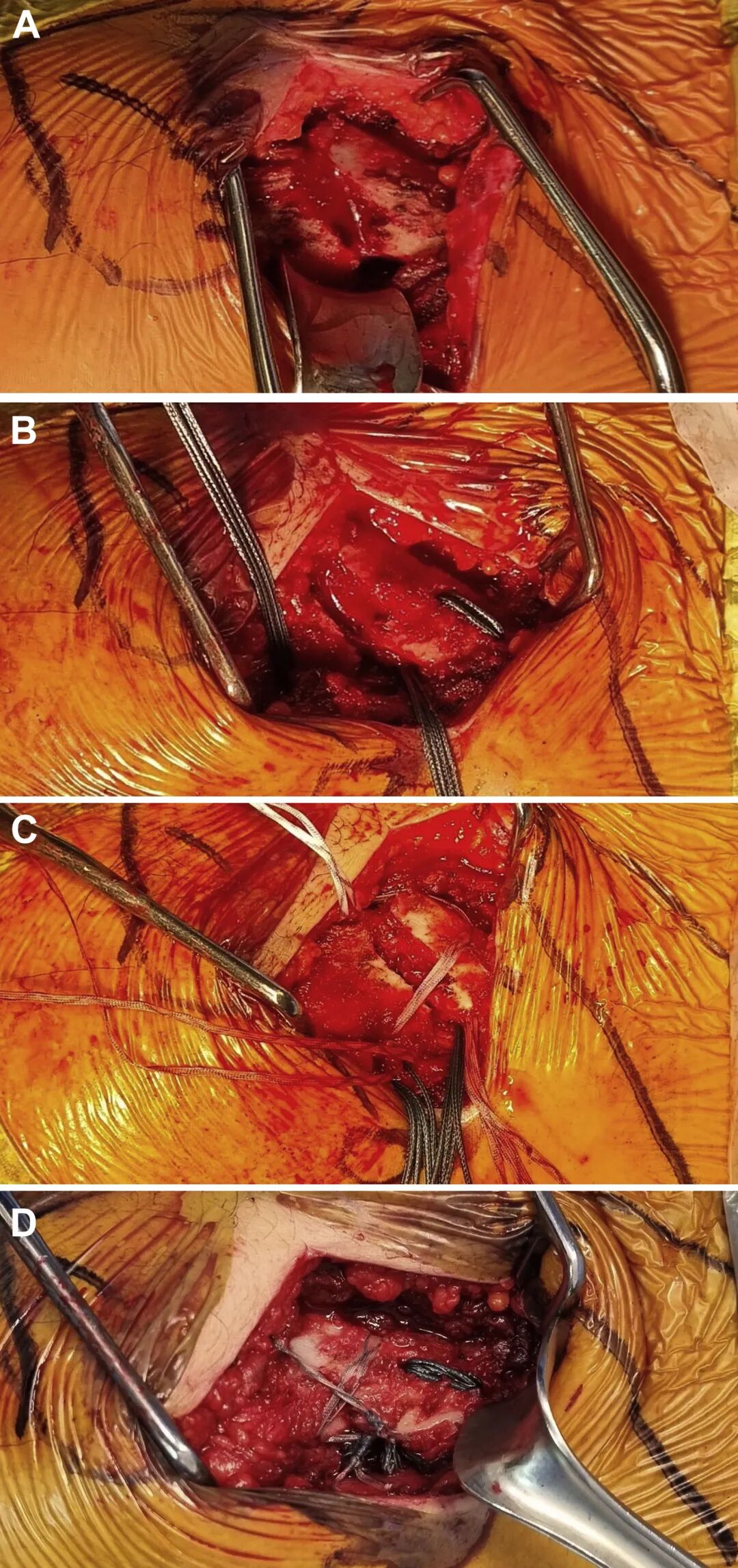 Illustration 4 for 突破传统！Neer II型V型锁骨远端不稳定骨折新解方：全缝合技术颠覆内固定，告别二次取出烦恼，助您稳固速愈，重获健康！