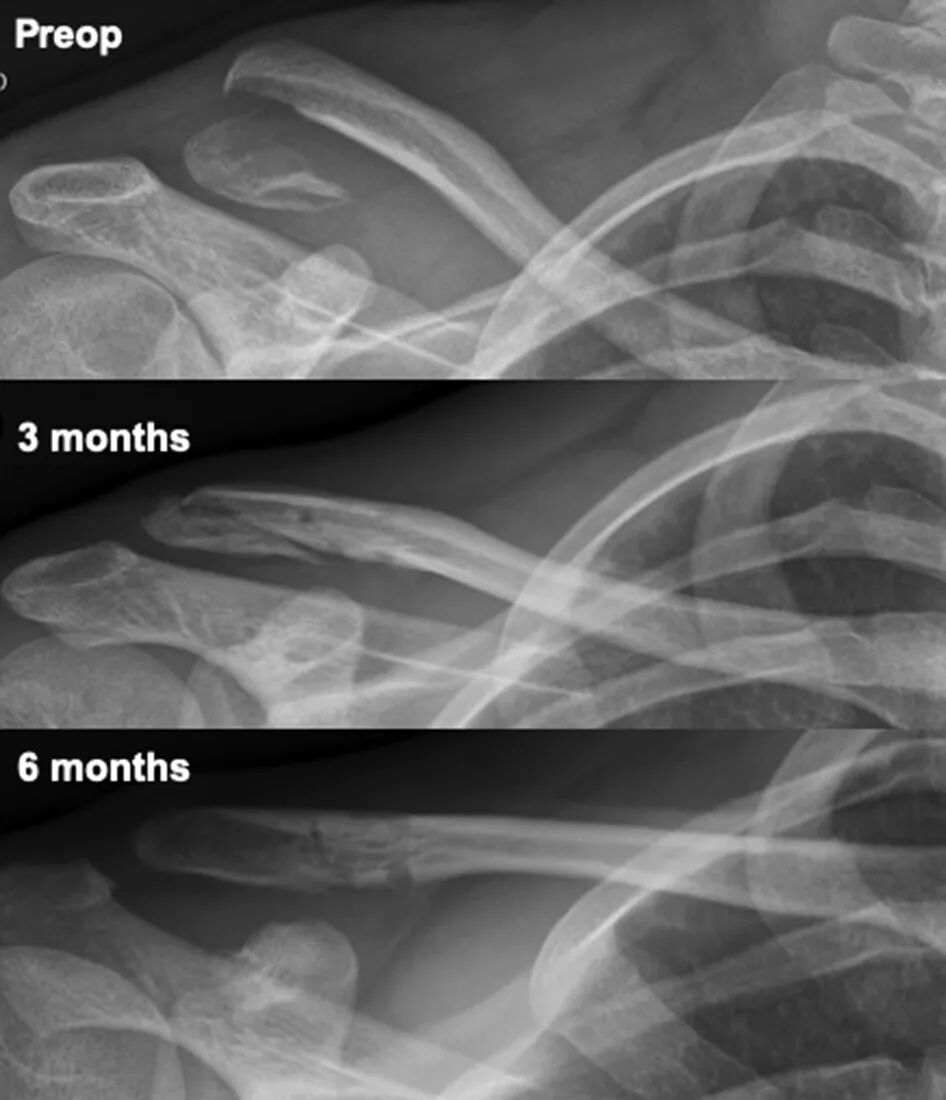 Illustration 5 for 突破传统！Neer II型V型锁骨远端不稳定骨折新解方：全缝合技术颠覆内固定，告别二次取出烦恼，助您稳固速愈，重获健康！