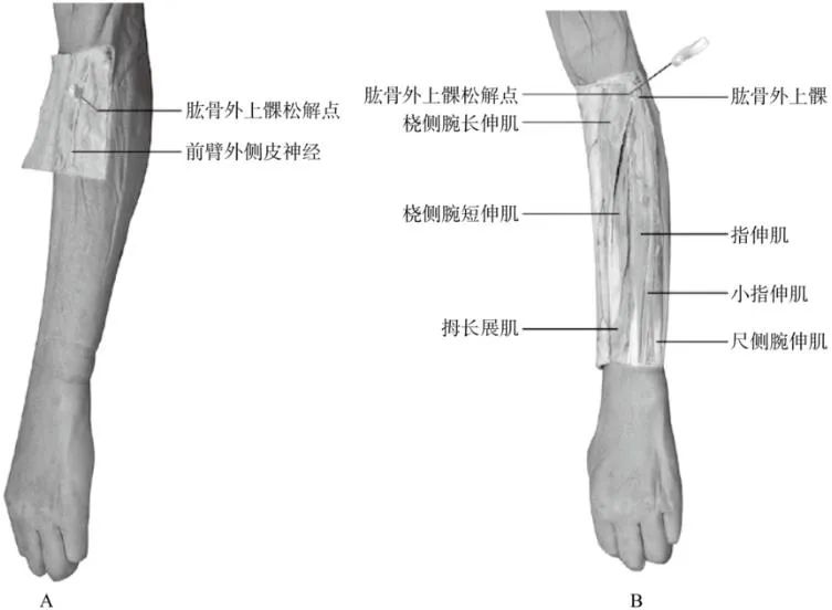 簡便驗廉肱骨外上髁炎的針刀療法