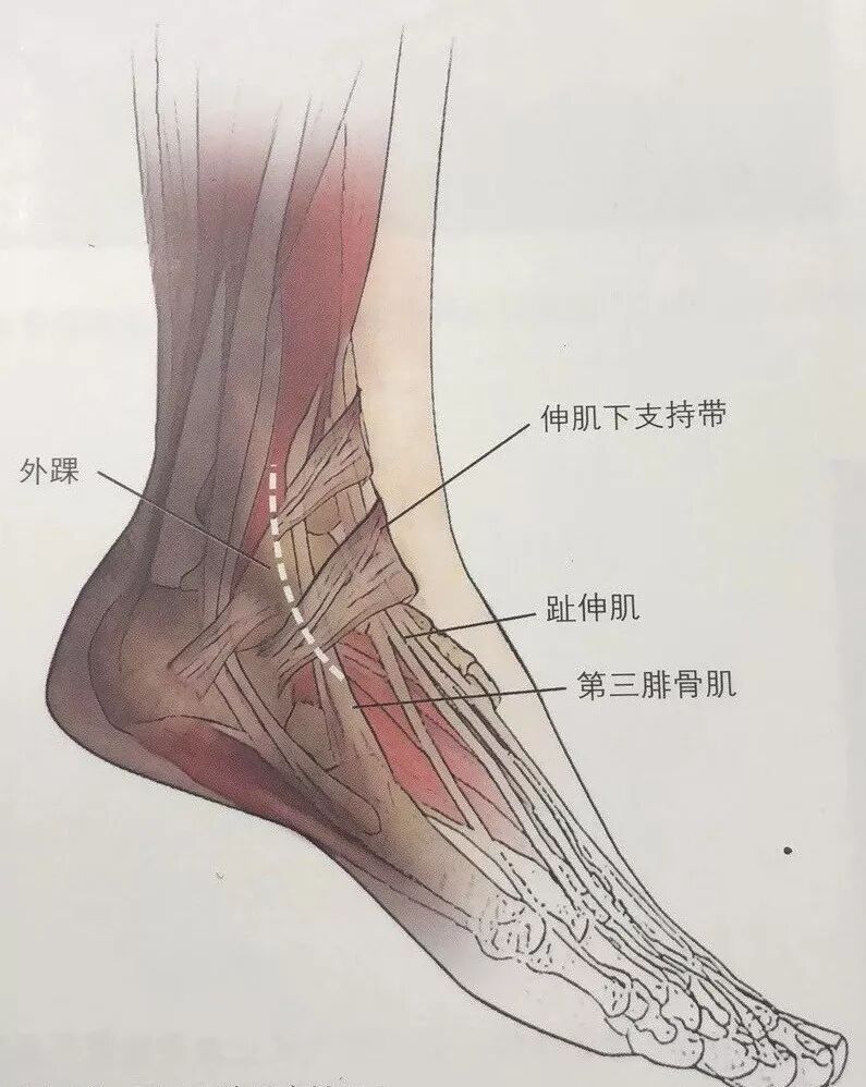 距骨颈骨折切开复位内固定技术 骨今中外 微信公众号文章阅读 Wemp