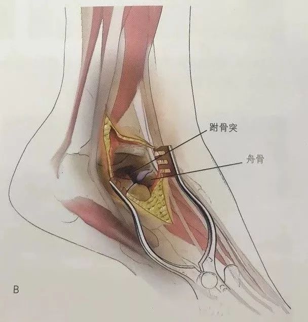 距骨颈骨折切开复位内固定技术 骨今中外 微信公众号文章阅读 Wemp