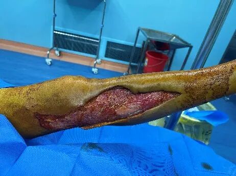 皮肤闭合器怎么拆荐读：如何使用Nice自锁线结牵张技术闭合皮肤创面？简单又有效！_https://www.jmylbn.com_新闻资讯_第1张