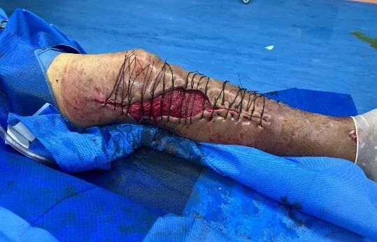 皮肤闭合器怎么拆荐读：如何使用Nice自锁线结牵张技术闭合皮肤创面？简单又有效！_https://www.jmylbn.com_新闻资讯_第4张