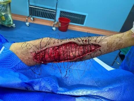 皮肤闭合器怎么拆荐读：如何使用Nice自锁线结牵张技术闭合皮肤创面？简单又有效！_https://www.jmylbn.com_新闻资讯_第2张