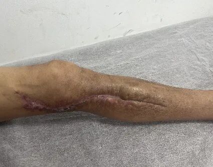 皮肤闭合器怎么拆荐读：如何使用Nice自锁线结牵张技术闭合皮肤创面？简单又有效！_https://www.jmylbn.com_新闻资讯_第6张