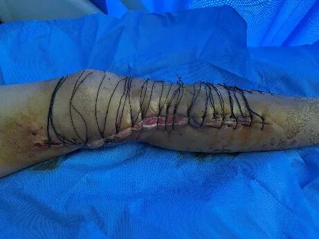 皮肤闭合器怎么拆荐读：如何使用Nice自锁线结牵张技术闭合皮肤创面？简单又有效！_https://www.jmylbn.com_新闻资讯_第5张