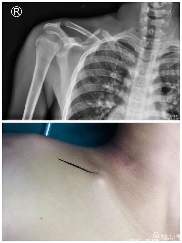 Illustration 15 for 锁骨骨折怕留疤？MIPO微创技术给你MIPO新选择！MIPO专家解析：解锁快速美观愈合秘诀