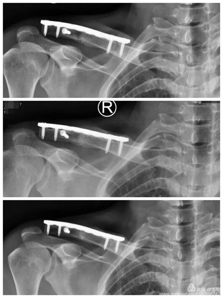 Illustration 25 for 锁骨骨折怕留疤？MIPO微创技术给你MIPO新选择！MIPO专家解析：解锁快速美观愈合秘诀