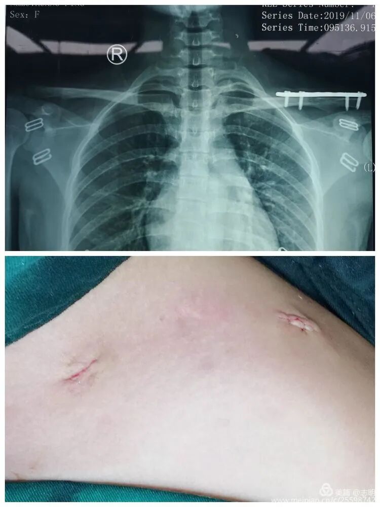 Illustration 14 for 锁骨骨折怕留疤？MIPO微创技术给你MIPO新选择！MIPO专家解析：解锁快速美观愈合秘诀