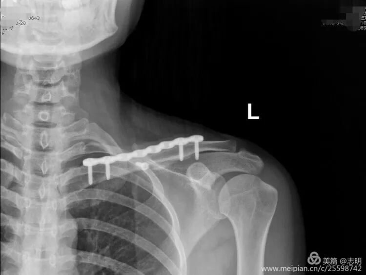 Illustration 22 for 锁骨骨折怕留疤？MIPO微创技术给你MIPO新选择！MIPO专家解析：解锁快速美观愈合秘诀