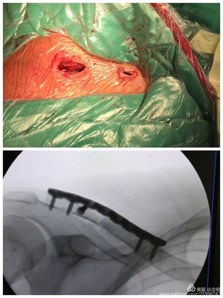 Illustration 24 for 锁骨骨折怕留疤？MIPO微创技术给你MIPO新选择！MIPO专家解析：解锁快速美观愈合秘诀