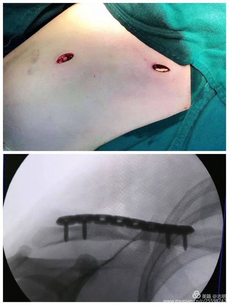 Illustration 16 for 锁骨骨折怕留疤？MIPO微创技术给你MIPO新选择！MIPO专家解析：解锁快速美观愈合秘诀