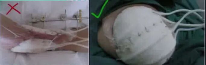 为什么负压引流图文详解：骨科常用负压封闭引流技术_https://www.jmylbn.com_新闻资讯_第6张