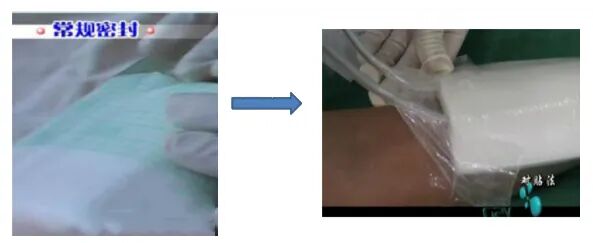 为什么负压引流图文详解：骨科常用负压封闭引流技术_https://www.jmylbn.com_新闻资讯_第3张