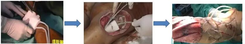 为什么负压引流图文详解：骨科常用负压封闭引流技术_https://www.jmylbn.com_新闻资讯_第2张