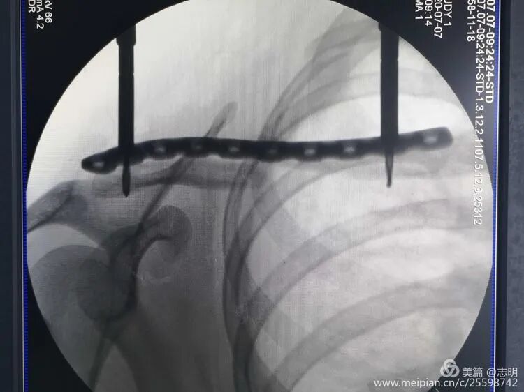 Illustration 6 for 锁骨骨折怕留疤？MIPO微创技术给你MIPO新选择！MIPO专家解析：解锁快速美观愈合秘诀