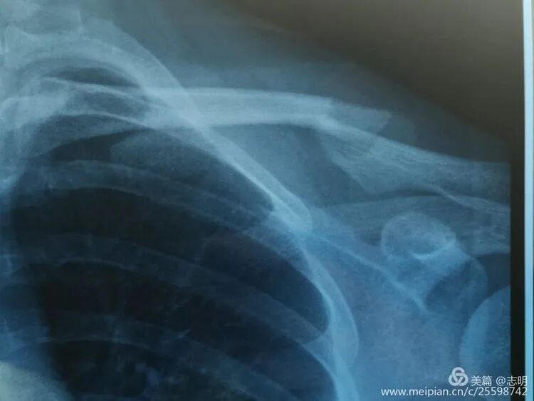 Illustration 11 for 锁骨骨折怕留疤？MIPO微创技术给你MIPO新选择！MIPO专家解析：解锁快速美观愈合秘诀