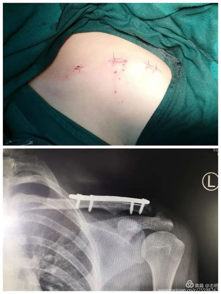 Illustration 13 for 锁骨骨折怕留疤？MIPO微创技术给你MIPO新选择！MIPO专家解析：解锁快速美观愈合秘诀