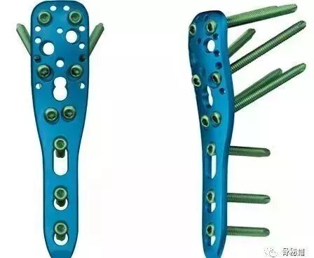 生物钉是什么材料骨折常用内固定材料&选择原则，超详细！_https://www.jmylbn.com_新闻资讯_第16张