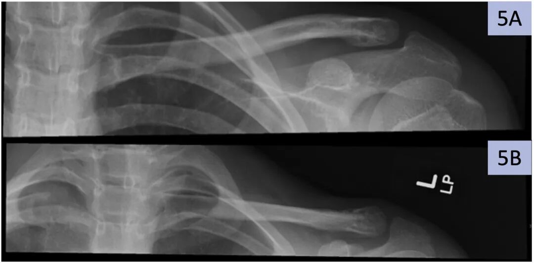 缝线怎么吸收手把手教学：用不可吸收缝线固定小儿锁骨远端_https://www.jmylbn.com_新闻资讯_第6张