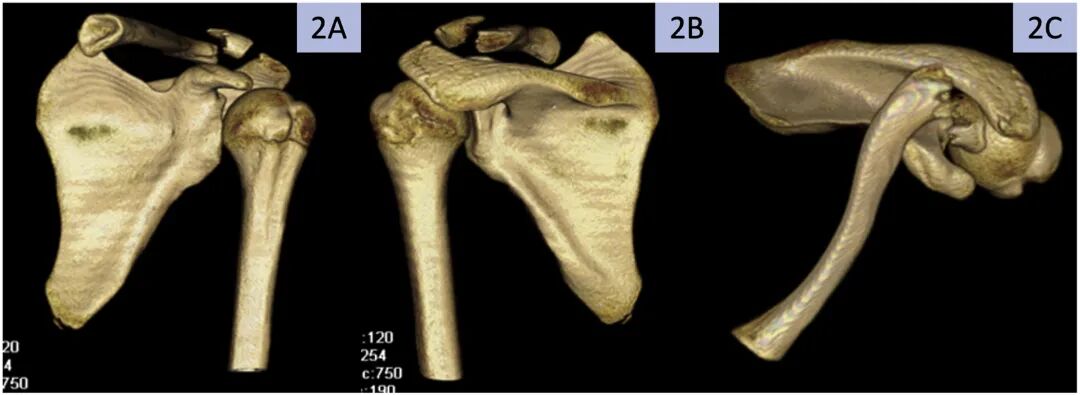 缝线怎么吸收手把手教学：用不可吸收缝线固定小儿锁骨远端_https://www.jmylbn.com_新闻资讯_第3张