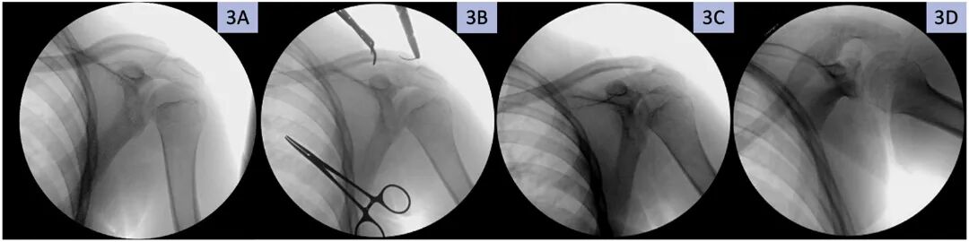 缝线怎么吸收手把手教学：用不可吸收缝线固定小儿锁骨远端_https://www.jmylbn.com_新闻资讯_第4张