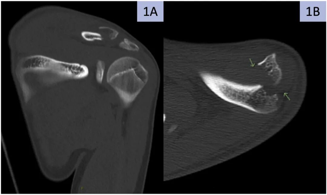 缝线怎么吸收手把手教学：用不可吸收缝线固定小儿锁骨远端_https://www.jmylbn.com_新闻资讯_第2张