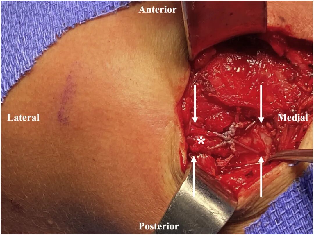 缝线怎么吸收手把手教学：用不可吸收缝线固定小儿锁骨远端_https://www.jmylbn.com_新闻资讯_第5张