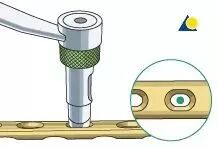 生物钉是什么材料骨折常用内固定材料&选择原则，超详细！_https://www.jmylbn.com_新闻资讯_第11张