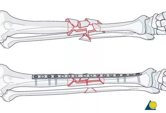 生物钉是什么材料骨折常用内固定材料&选择原则，超详细！_https://www.jmylbn.com_新闻资讯_第20张