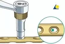 生物钉是什么材料骨折常用内固定材料&选择原则，超详细！_https://www.jmylbn.com_新闻资讯_第10张